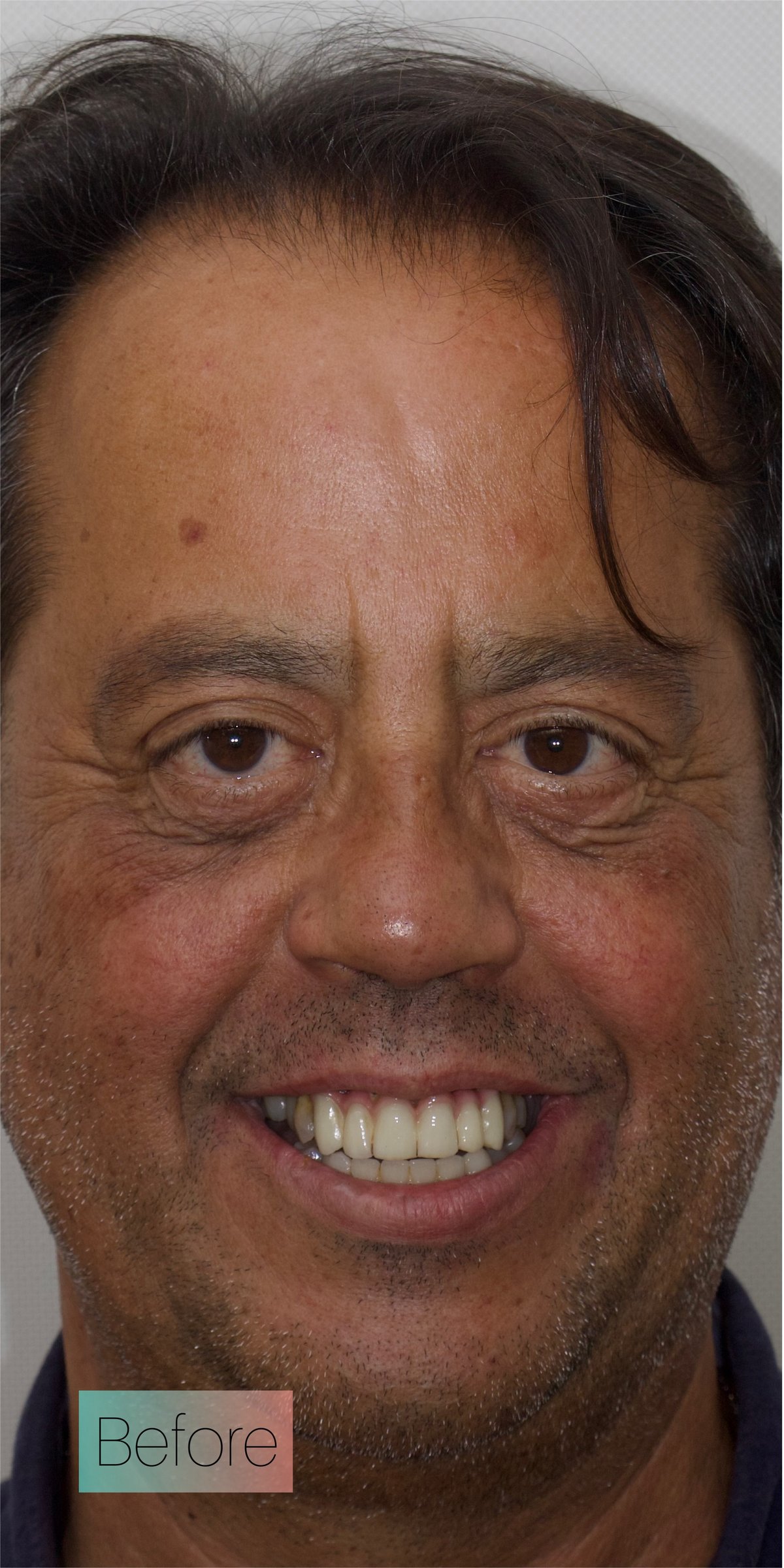 Alfonso antes del tratamiento en Dental Torres