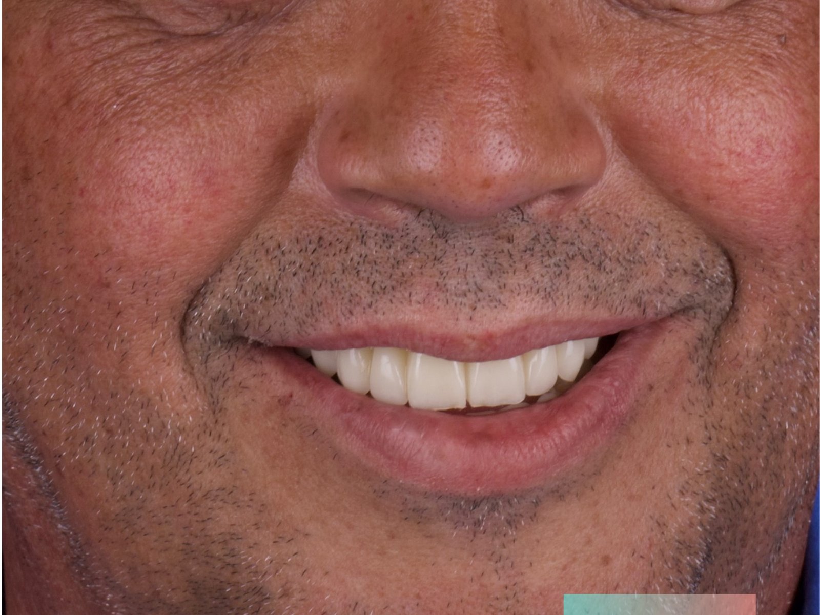 Arcadas completas rehabilitadas con zirconio