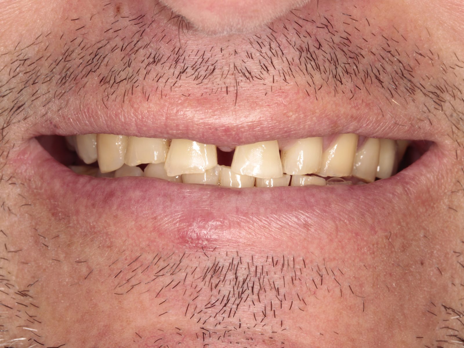 Desgaste dental severo por bruxismo