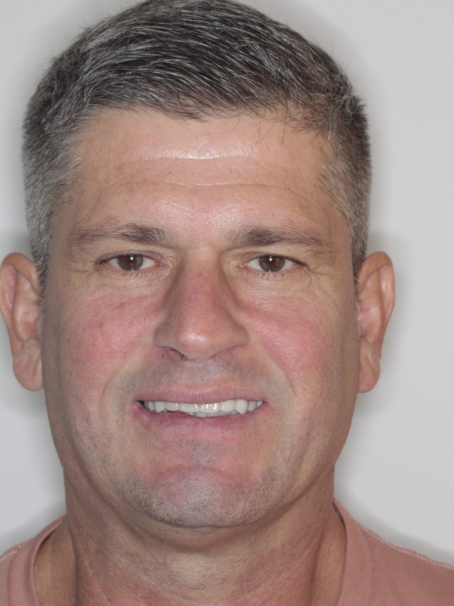 Paciente después del tratamiento — sonrisa rehabilitada con disilicato y composite
