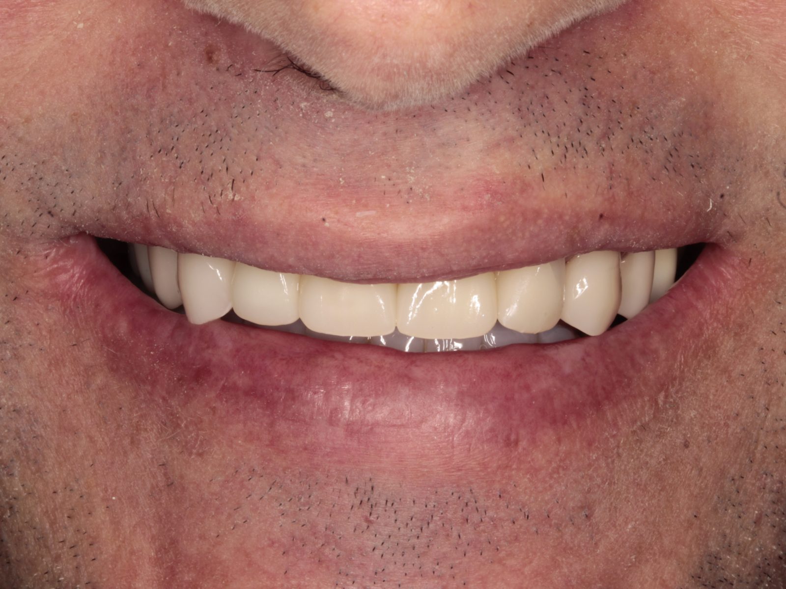 Sonrisa rehabilitada con carillas de disilicato y composite