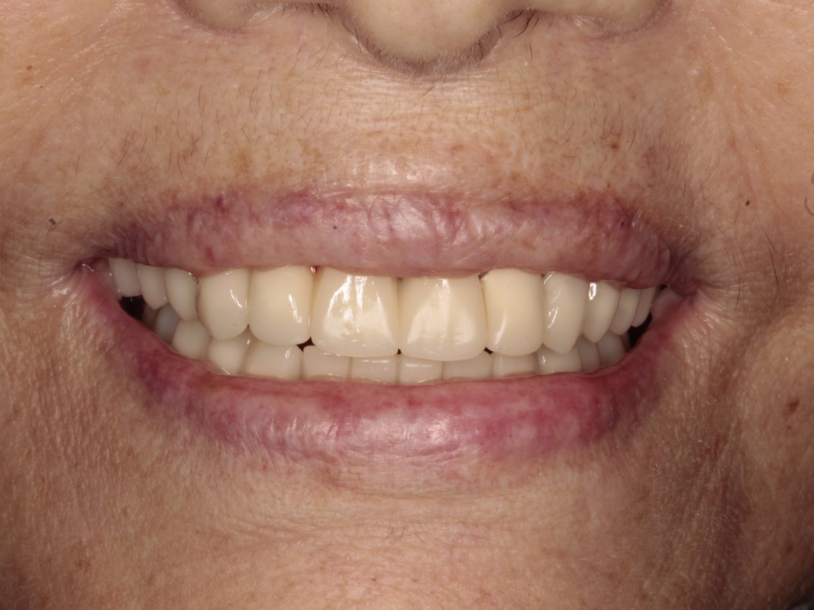 Coronas de zirconio en ambas arcadas — resultado final
